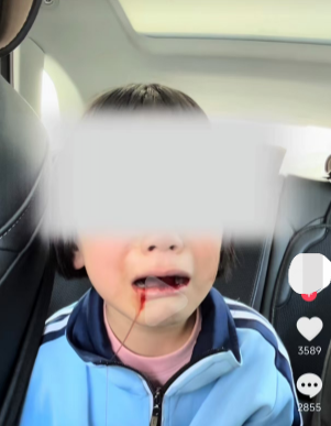 山西一年级女生被同学打得满嘴流血？当地回应