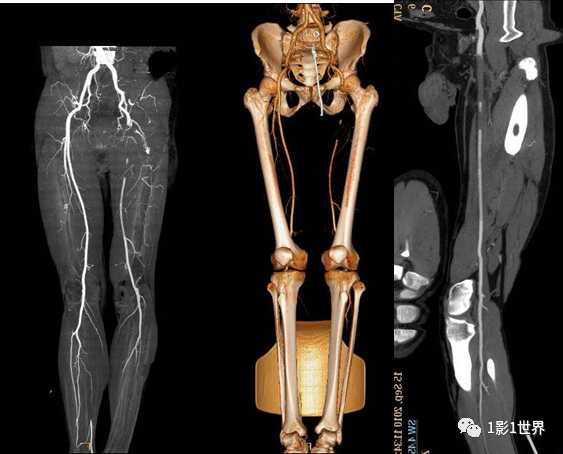 什么是外周支架话说介入 ｜ 外周血管狭窄，支架植入术_https://www.jmylbn.com_新闻资讯_第7张