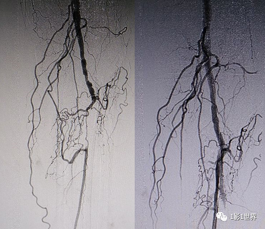 什么是外周支架话说介入 ｜ 外周血管狭窄，支架植入术_https://www.jmylbn.com_新闻资讯_第8张