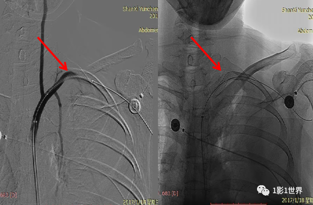 什么是外周支架话说介入 ｜ 外周血管狭窄，支架植入术_https://www.jmylbn.com_新闻资讯_第6张