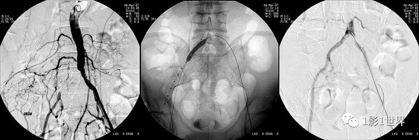 什么是外周支架话说介入 ｜ 外周血管狭窄，支架植入术_https://www.jmylbn.com_新闻资讯_第4张
