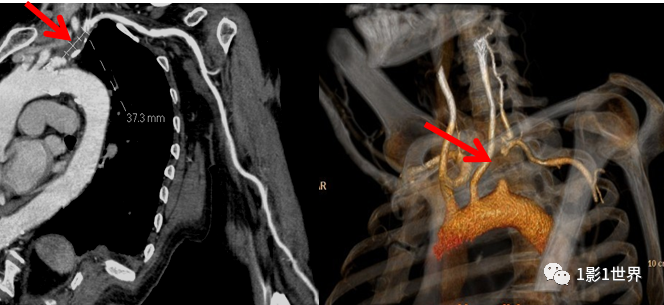 什么是外周支架话说介入 ｜ 外周血管狭窄，支架植入术_https://www.jmylbn.com_新闻资讯_第5张