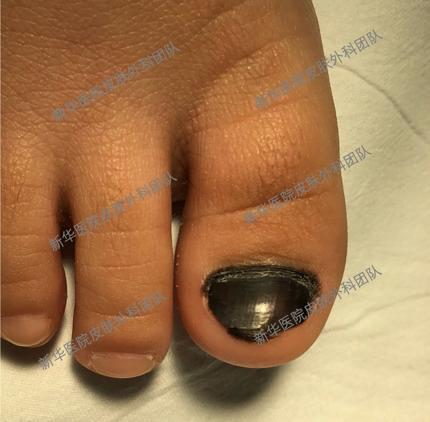 指甲上的"条形码" — 甲母痣_痣_介绍_发病原因_症状表现 - 好大夫