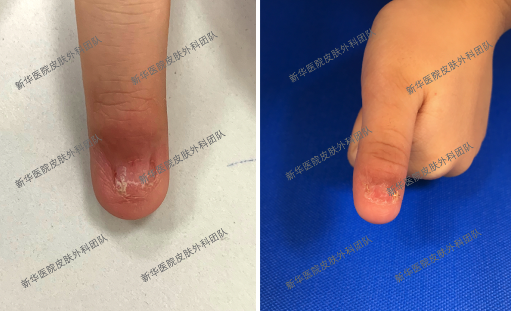 指甲上的"条形码" — 甲母痣_痣_介绍_发病原因_症状表现 - 好大夫