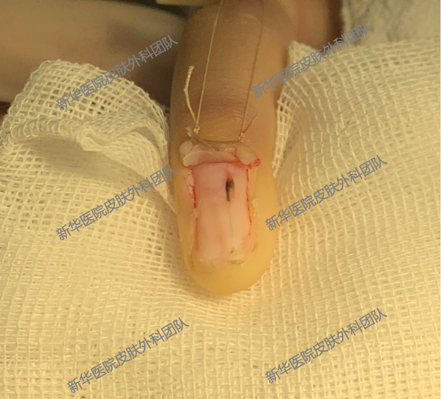 指甲上的"条形码" — 甲母痣_痣_介绍_发病原因_症状表现 - 好大夫