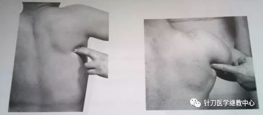 外展枕怎么使用干货 ｜ 针刀治疗要点规程定点定位_https://www.jmylbn.com_新闻资讯_第32张