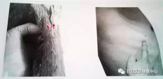 外展枕怎么使用干货 ｜ 针刀治疗要点规程定点定位_https://www.jmylbn.com_新闻资讯_第24张