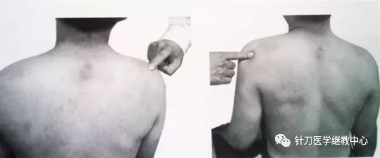 外展枕怎么使用干货 ｜ 针刀治疗要点规程定点定位_https://www.jmylbn.com_新闻资讯_第16张
