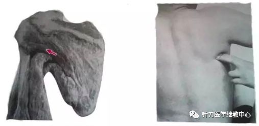 外展枕怎么使用干货 ｜ 针刀治疗要点规程定点定位_https://www.jmylbn.com_新闻资讯_第40张