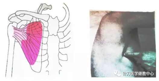 外展枕怎么使用干货 ｜ 针刀治疗要点规程定点定位_https://www.jmylbn.com_新闻资讯_第38张