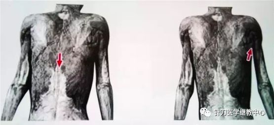 外展枕怎么使用干货 ｜ 针刀治疗要点规程定点定位_https://www.jmylbn.com_新闻资讯_第31张