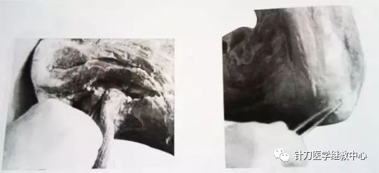 外展枕怎么使用干货 ｜ 针刀治疗要点规程定点定位_https://www.jmylbn.com_新闻资讯_第34张