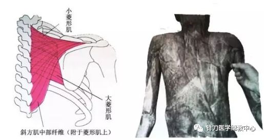 外展枕怎么使用干货 ｜ 针刀治疗要点规程定点定位_https://www.jmylbn.com_新闻资讯_第43张