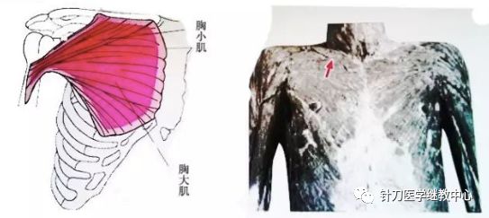 外展枕怎么使用干货 ｜ 针刀治疗要点规程定点定位_https://www.jmylbn.com_新闻资讯_第28张