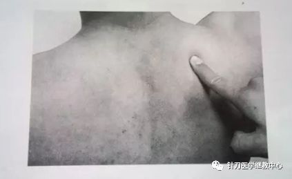 外展枕怎么使用干货 ｜ 针刀治疗要点规程定点定位_https://www.jmylbn.com_新闻资讯_第27张