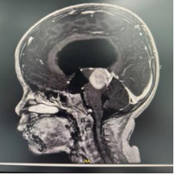 首例！上海儿童医学中心在脑肿瘤治疗领域实现了细胞级精准突破！(图5)
