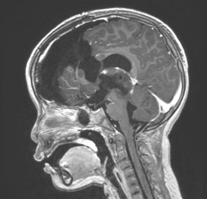 首例！上海儿童医学中心在脑肿瘤治疗领域实现了细胞级精准突破！(图8)
