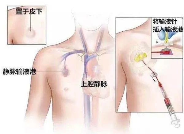 加压输液什么意思输液港：肿瘤、长期输液患者的“幸福港湾”——榆林市中医医院开展胸壁输液港植入术_https://www.jmylbn.com_新闻资讯_第3张