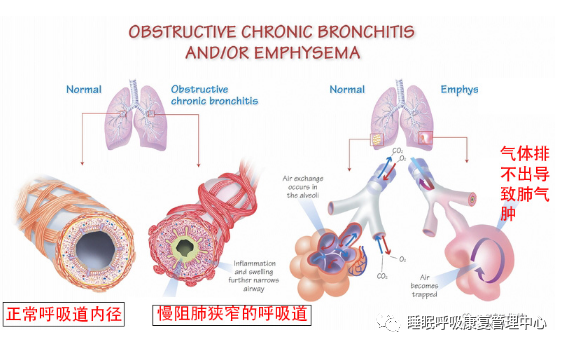 呼吸机怎么制氧慢阻肺用呼吸机好还是制氧机好_https://www.jmylbn.com_新闻资讯_第1张