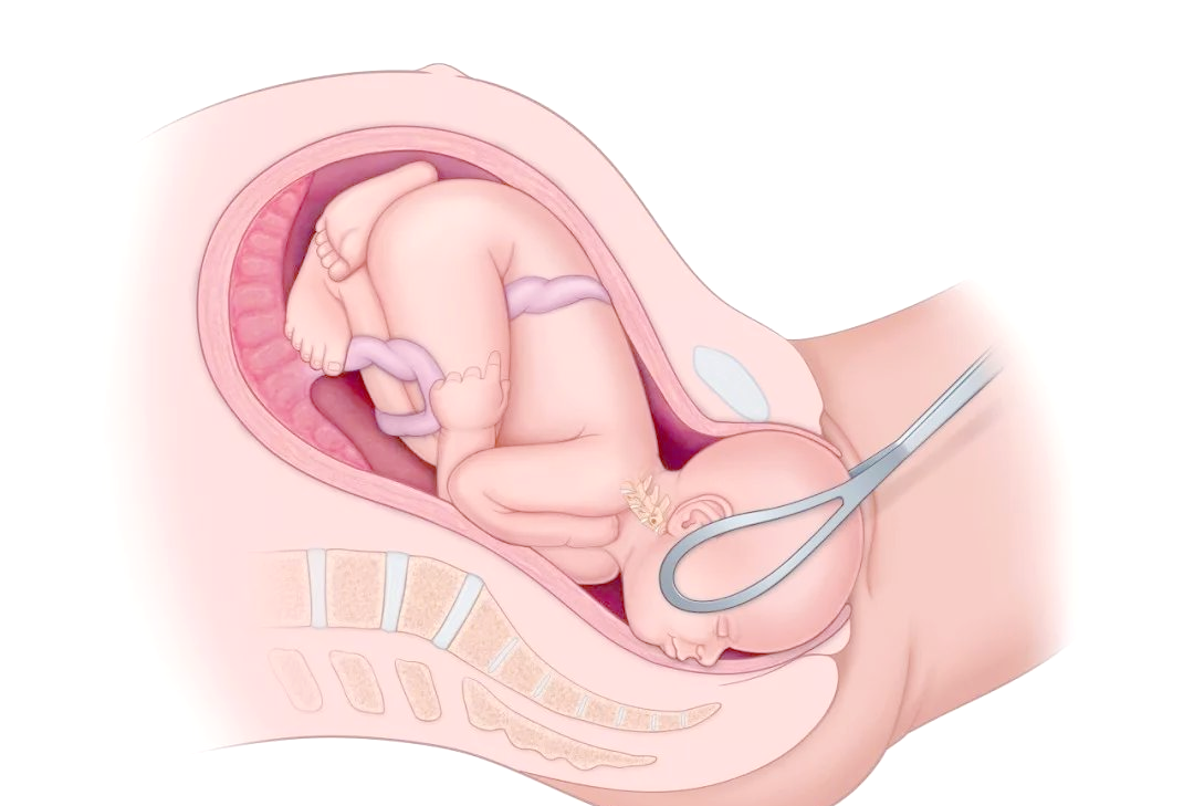 kielland产钳怎么翻译近乎失传的高难度产钳术，产科成功实施并实现“零痕迹”助产_https://www.jmylbn.com_新闻资讯_第4张