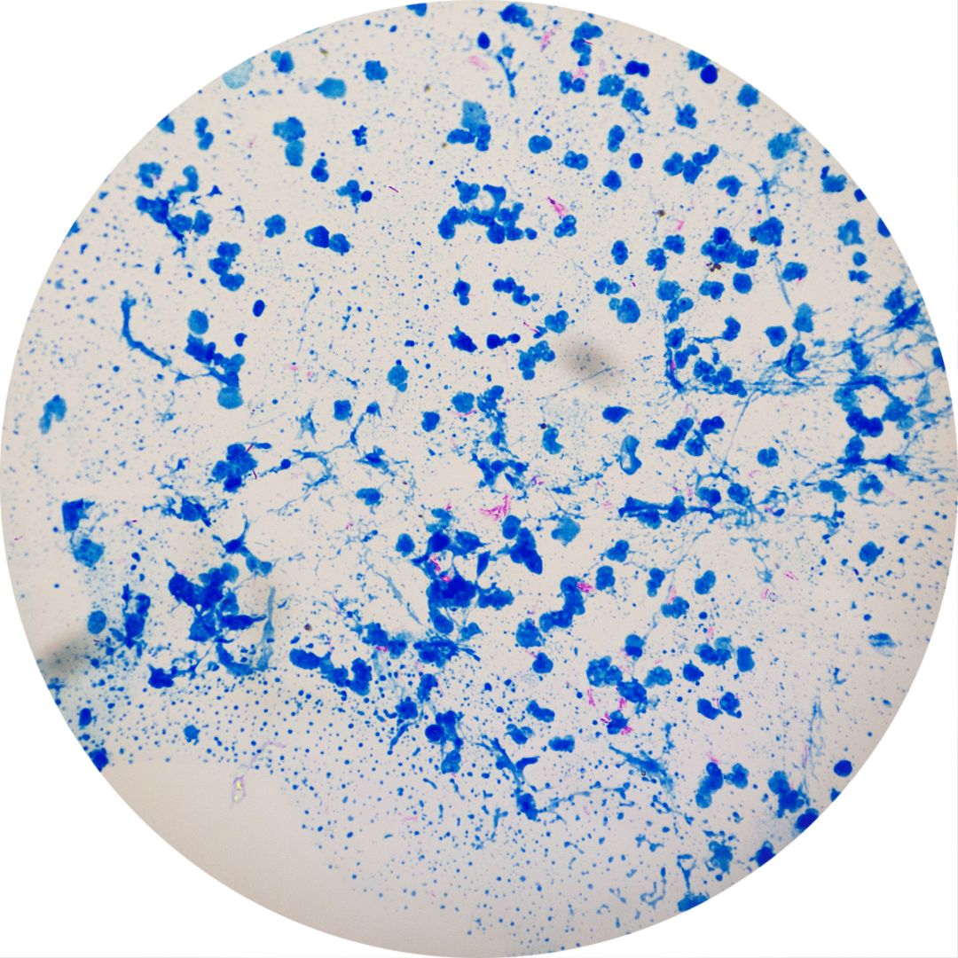 肺结核:结核分枝杆菌,属于细菌感染.