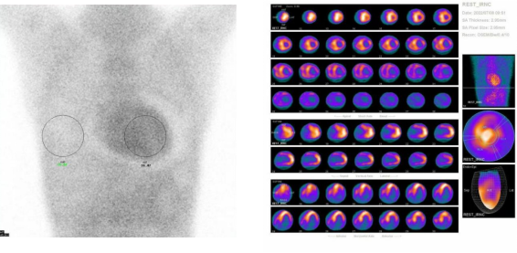 d-spect怎么检查【迎盛会 铸忠诚 强担当 创业绩】我院核医学科成功完成首例^99mTc-PYP心肌淀粉样变SPECT／CT显像_https://www.jmylbn.com_新闻资讯_第7张