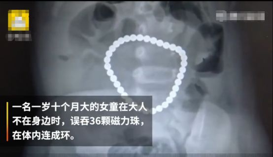 快檢查你家有沒有這種毒玩具，2歲女童腹中竟出現「手鏈」，網友：這孩子是蚌精嗎 親子 第2張