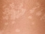 慌了！寶寶皮膚上的各種斑是疾病的徵兆？有這4種就需要注意了 親子 第8張