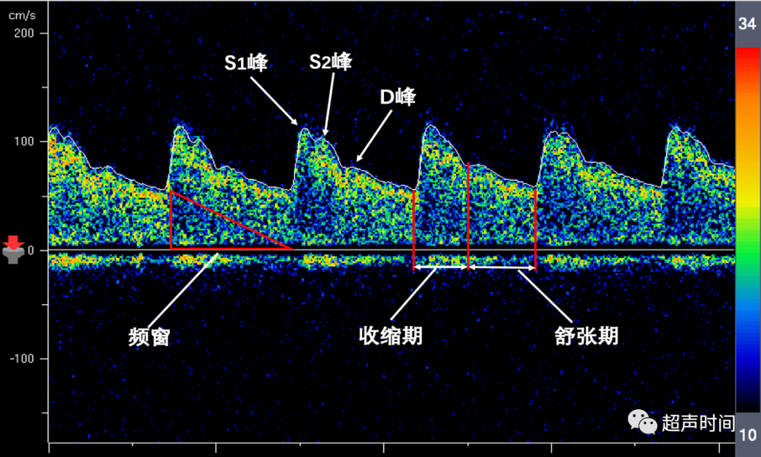 TCD怎么切换探头【血管超声】经颅多普勒（TCD）基础知识及临床应用_https://www.jmylbn.com_新闻资讯_第26张