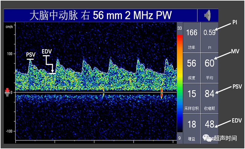 TCD怎么切换探头【血管超声】经颅多普勒（TCD）基础知识及临床应用_https://www.jmylbn.com_新闻资讯_第25张