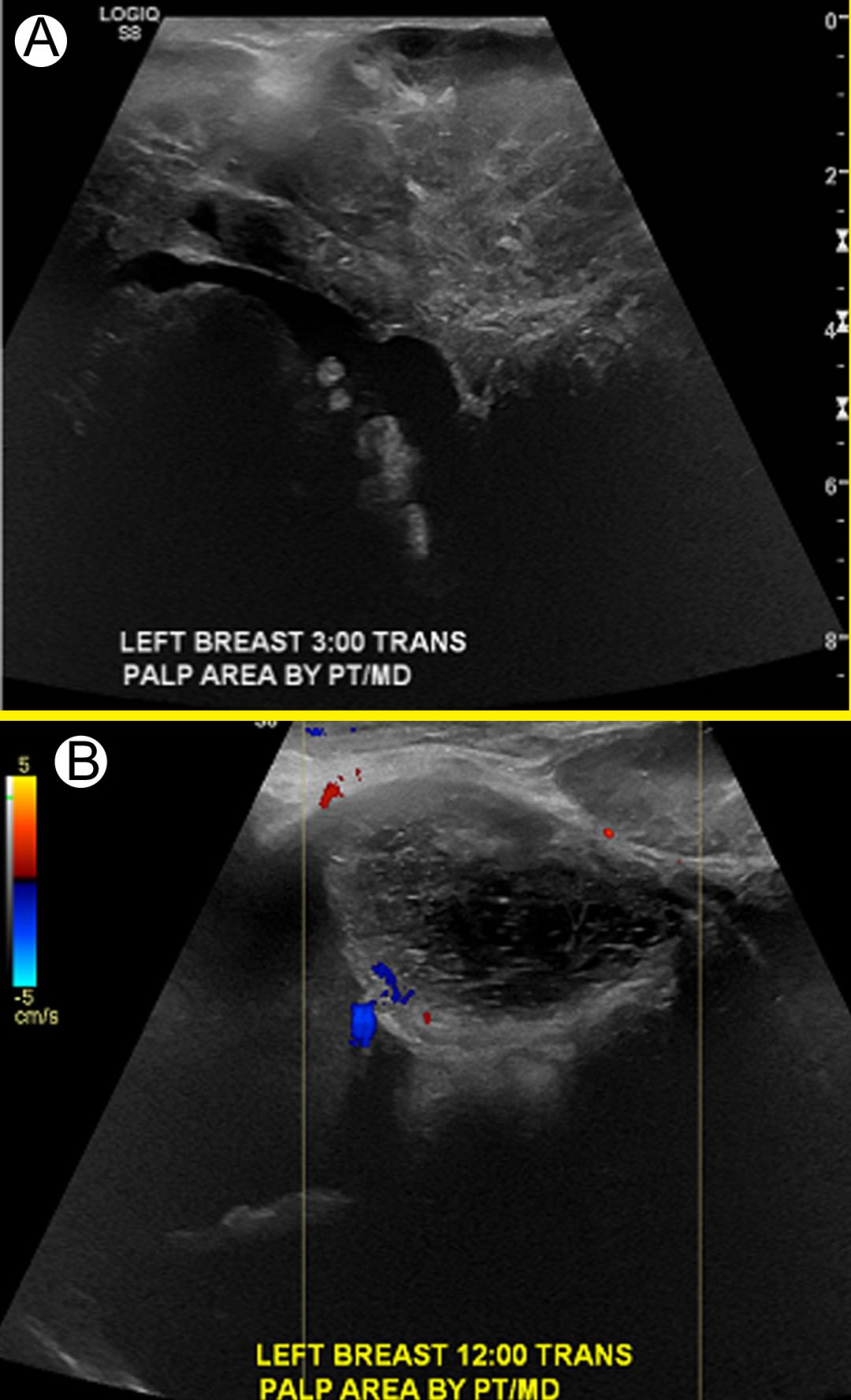 病例分享乳腺恶性叶状肿瘤