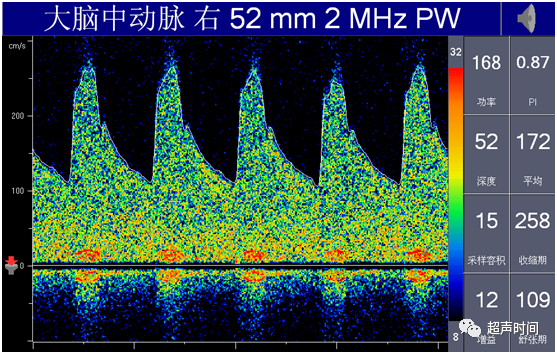 TCD怎么切换探头【血管超声】经颅多普勒（TCD）基础知识及临床应用_https://www.jmylbn.com_新闻资讯_第28张