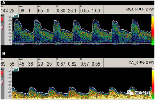 TCD怎么切换探头【血管超声】经颅多普勒（TCD）基础知识及临床应用_https://www.jmylbn.com_新闻资讯_第33张