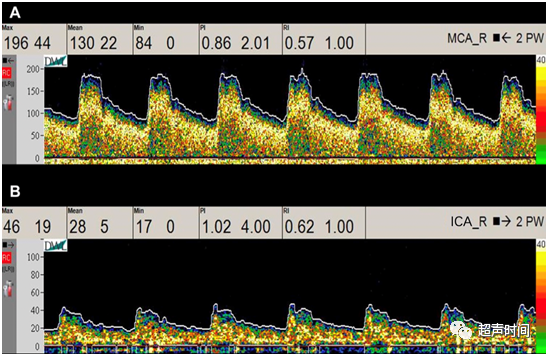 TCD怎么切换探头【血管超声】经颅多普勒（TCD）基础知识及临床应用_https://www.jmylbn.com_新闻资讯_第32张
