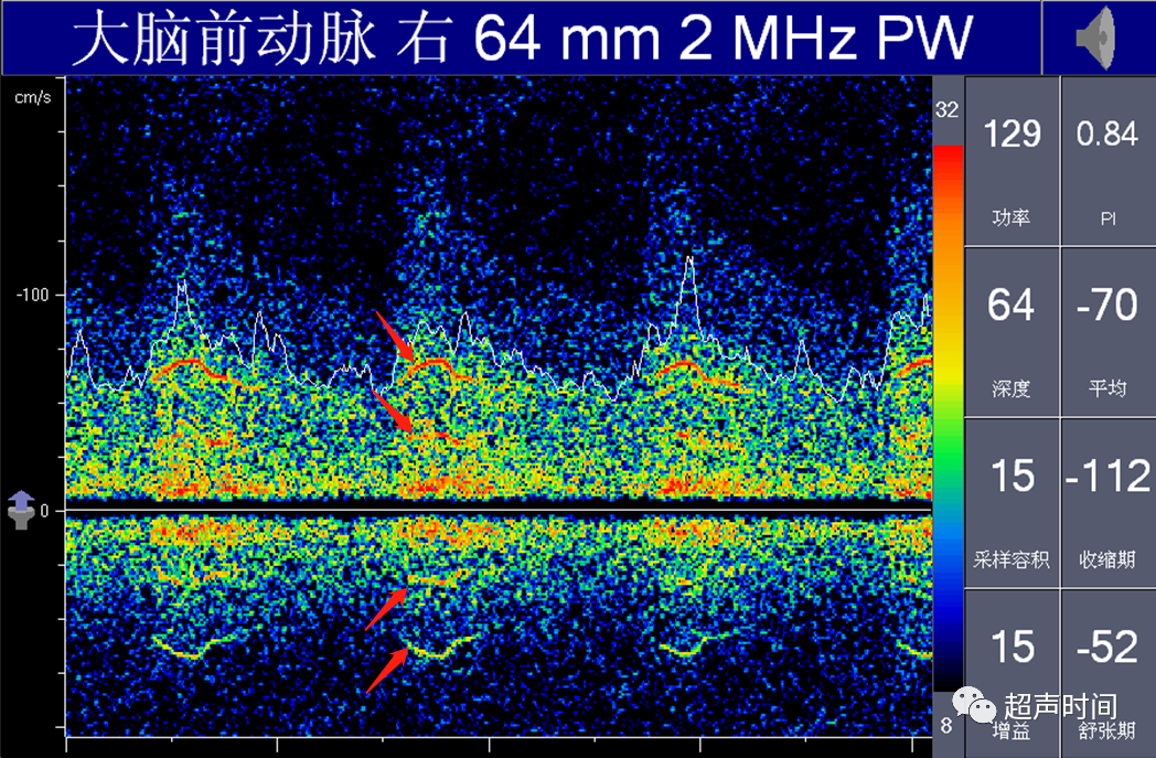 TCD怎么切换探头【血管超声】经颅多普勒（TCD）基础知识及临床应用_https://www.jmylbn.com_新闻资讯_第27张
