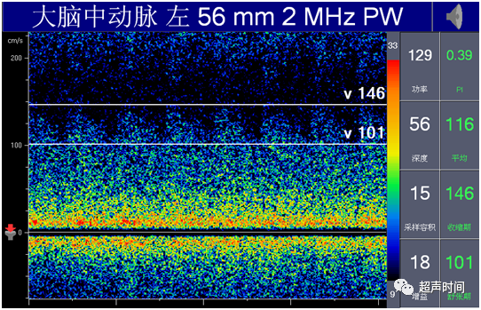 TCD怎么切换探头【血管超声】经颅多普勒（TCD）基础知识及临床应用_https://www.jmylbn.com_新闻资讯_第31张