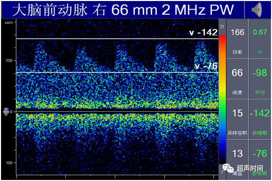 TCD怎么切换探头【血管超声】经颅多普勒（TCD）基础知识及临床应用_https://www.jmylbn.com_新闻资讯_第29张