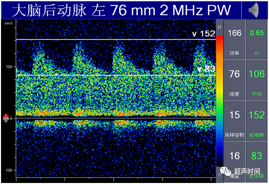 TCD怎么切换探头【血管超声】经颅多普勒（TCD）基础知识及临床应用_https://www.jmylbn.com_新闻资讯_第30张