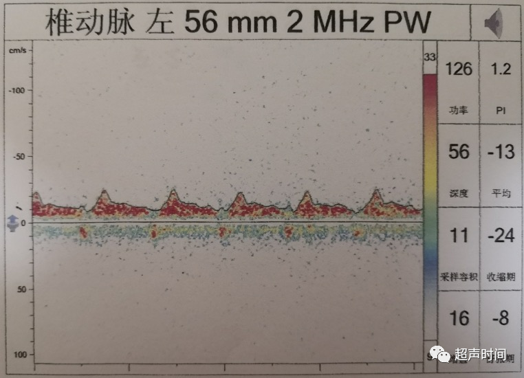 TCD怎么切换探头【血管超声】经颅多普勒（TCD）基础知识及临床应用_https://www.jmylbn.com_新闻资讯_第37张