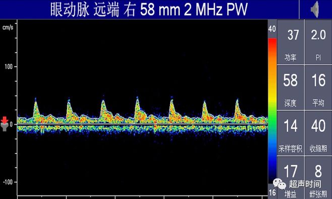 TCD怎么切换探头TCD：经颅多普勒(1-2)：基础知识、检查操作_https://www.jmylbn.com_新闻资讯_第14张