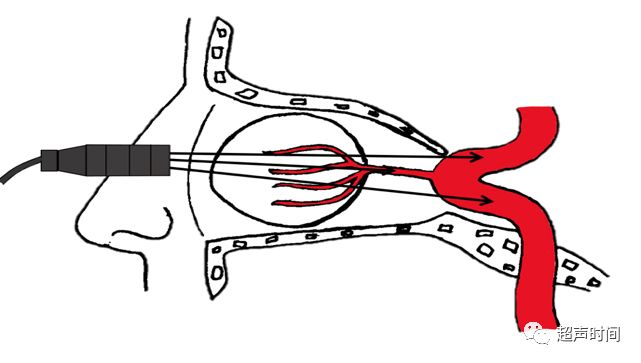 TCD怎么切换探头TCD：经颅多普勒(1-2)：基础知识、检查操作_https://www.jmylbn.com_新闻资讯_第11张