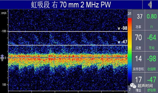 TCD怎么切换探头TCD：经颅多普勒(1-2)：基础知识、检查操作_https://www.jmylbn.com_新闻资讯_第13张