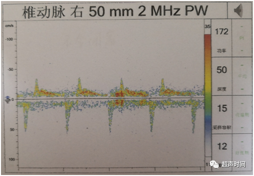 TCD怎么切换探头【血管超声】经颅多普勒（TCD）基础知识及临床应用_https://www.jmylbn.com_新闻资讯_第38张