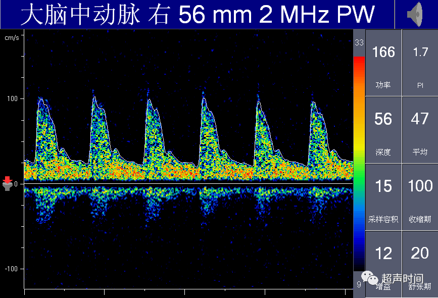 TCD怎么切换探头【血管超声】经颅多普勒（TCD）基础知识及临床应用_https://www.jmylbn.com_新闻资讯_第43张