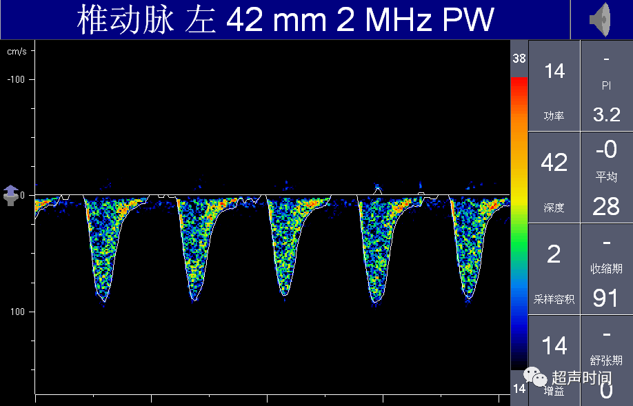 TCD怎么切换探头【血管超声】经颅多普勒（TCD）基础知识及临床应用_https://www.jmylbn.com_新闻资讯_第42张