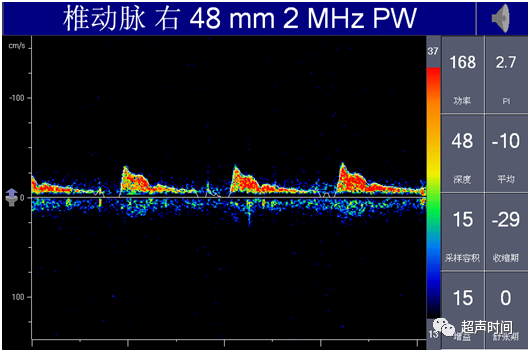 TCD怎么切换探头【血管超声】经颅多普勒（TCD）基础知识及临床应用_https://www.jmylbn.com_新闻资讯_第36张