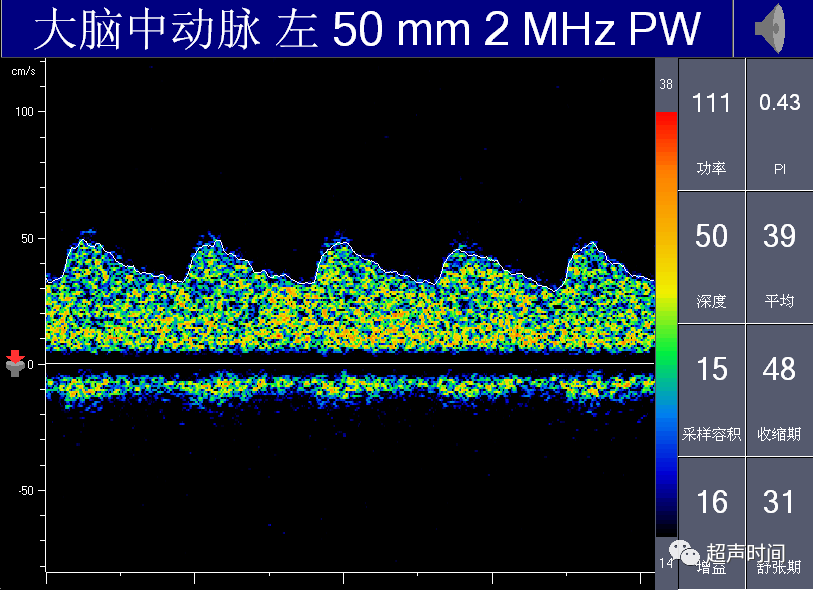 TCD怎么切换探头【血管超声】经颅多普勒（TCD）基础知识及临床应用_https://www.jmylbn.com_新闻资讯_第35张