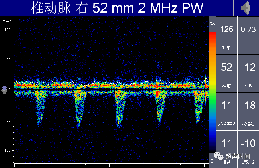 TCD怎么切换探头【血管超声】经颅多普勒（TCD）基础知识及临床应用_https://www.jmylbn.com_新闻资讯_第41张