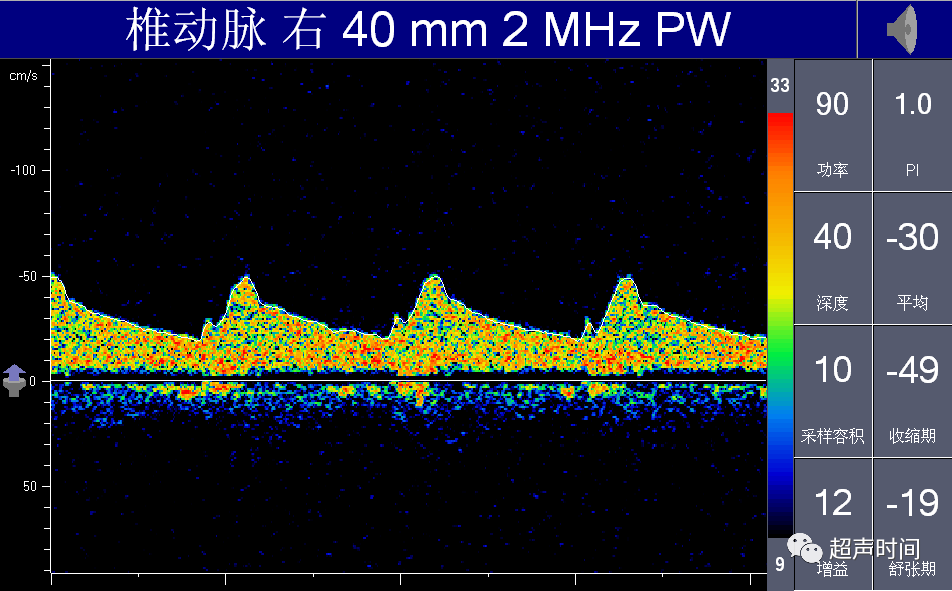 TCD怎么切换探头【血管超声】经颅多普勒（TCD）基础知识及临床应用_https://www.jmylbn.com_新闻资讯_第40张