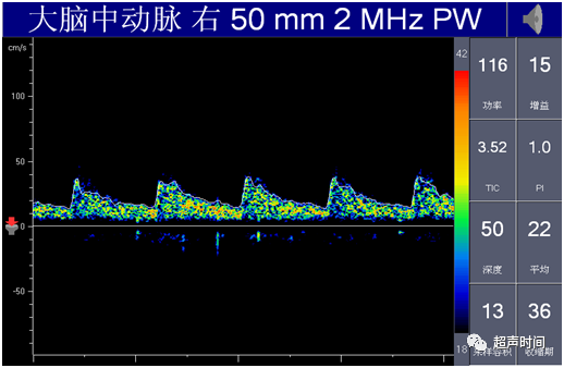 TCD怎么切换探头【血管超声】经颅多普勒（TCD）基础知识及临床应用_https://www.jmylbn.com_新闻资讯_第34张